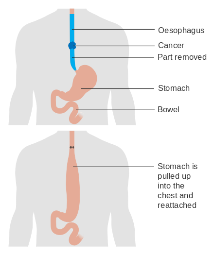 Diagram_showing_before_and_after_a_total_oesophagectomy_CRUK_105