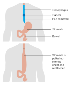 Diagram_showing_before_and_after_a_total_oesophagectomy_CRUK_105